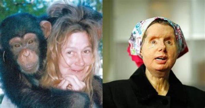Charla Nash Face Reveal After Getting Attacked By Chimpanzee- Before Surgery Photos And More