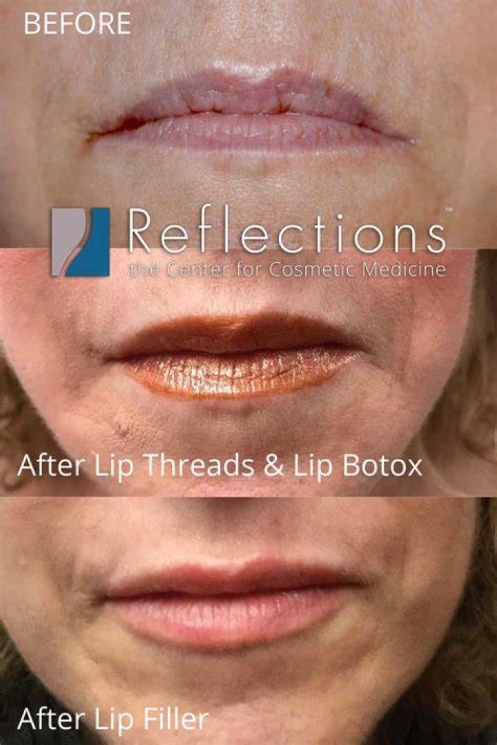 Ines Helene Before Plastic Surgery | Botox And Lip Filler