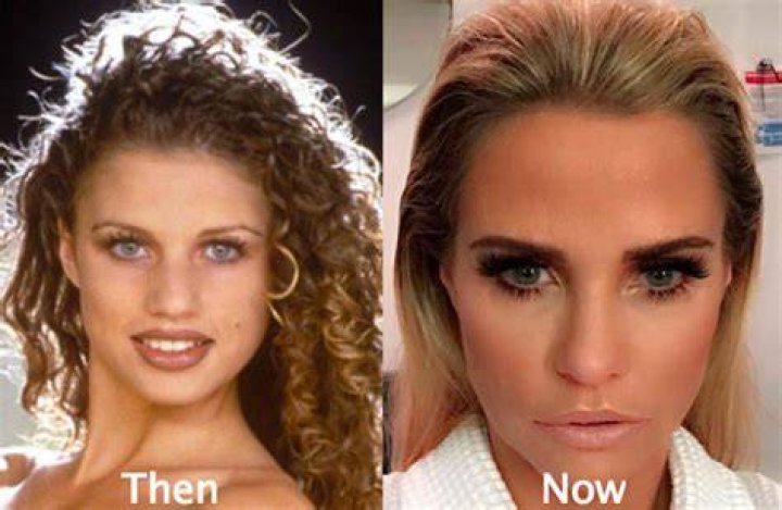 Katie Price Before Plastic Surgery: Did She Get Her Lips And Nose Done?